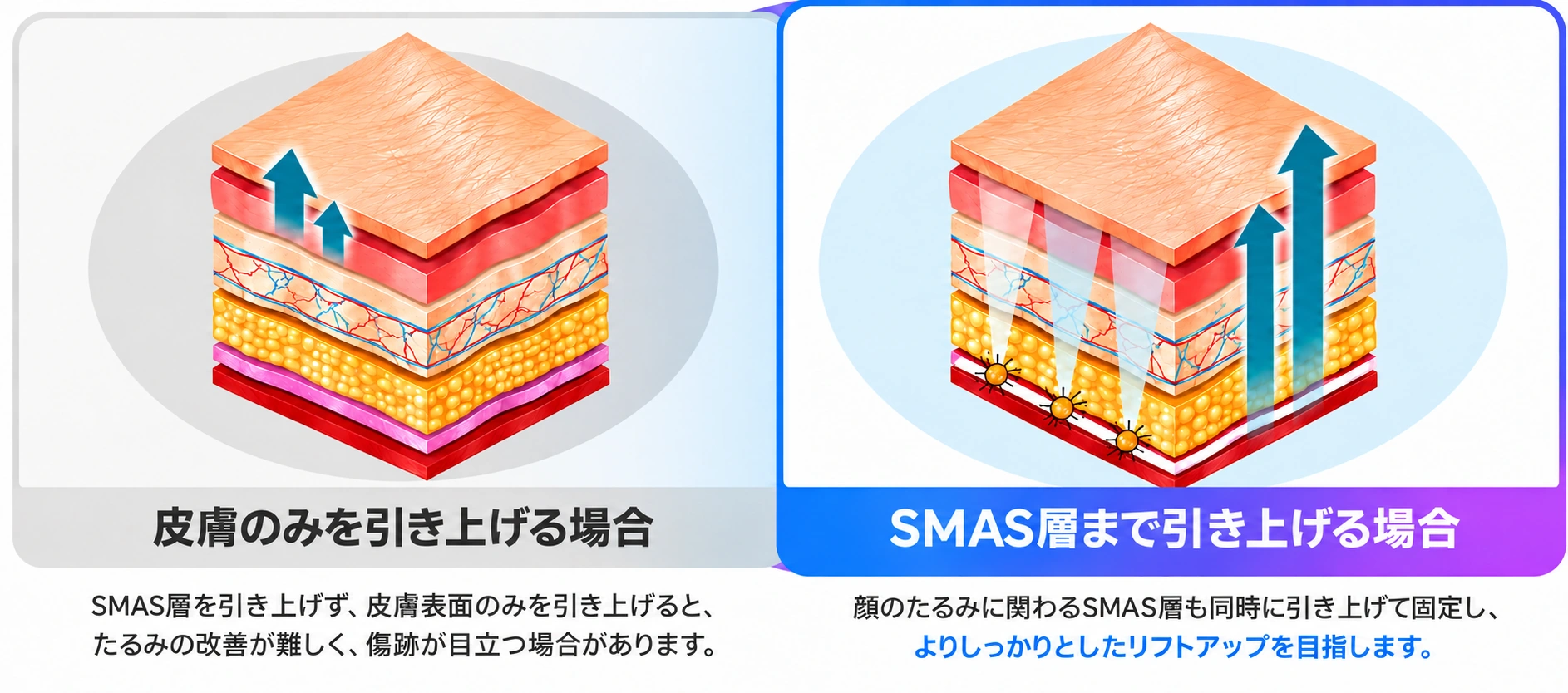 皮膚のみを引き上げる場合とSMAS層まで引き上げる場合の比較