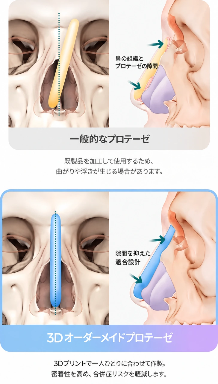 オーダーメイドのプロテーゼ設計