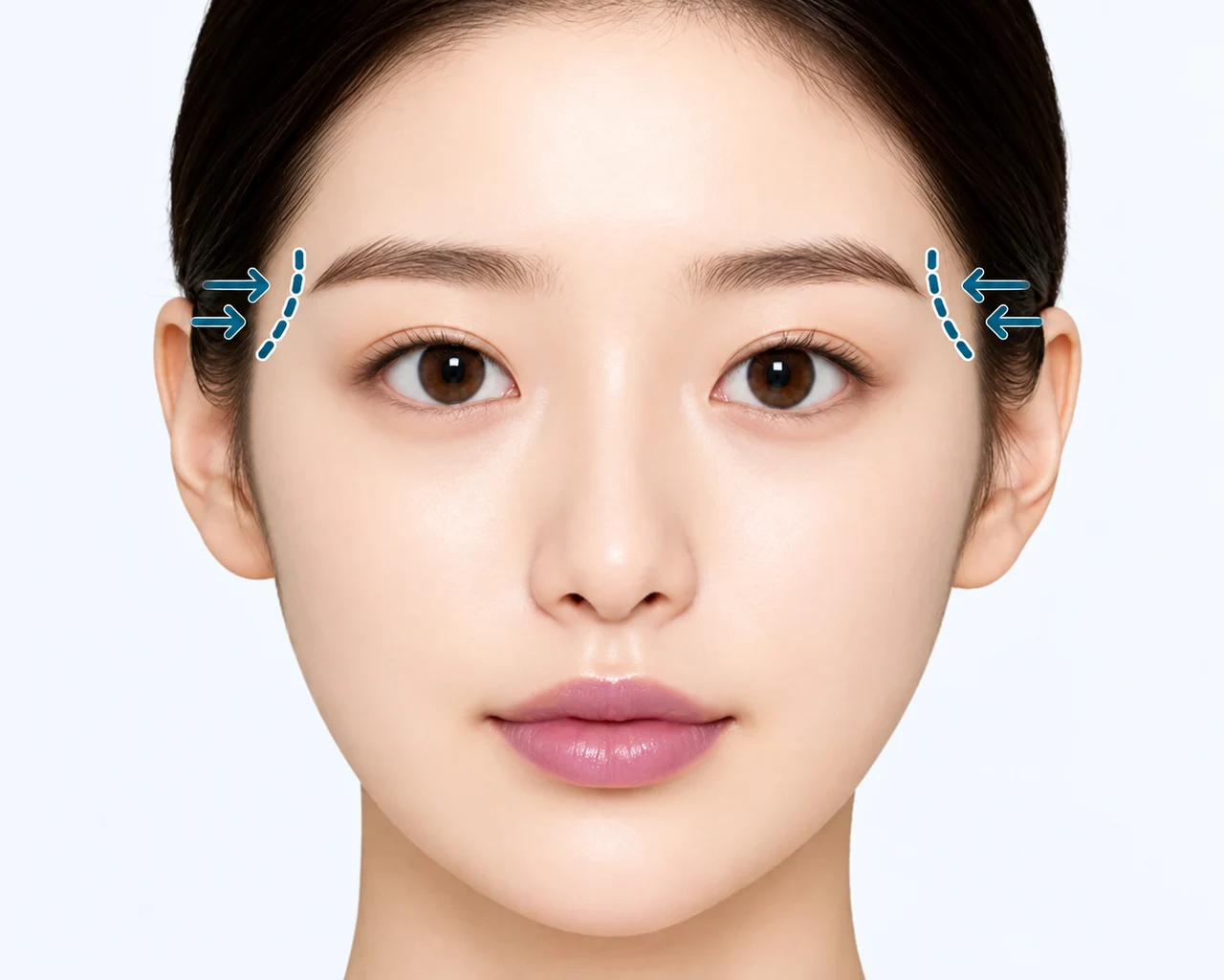 こめかみのくぼみでバランスが崩れた場合 — こめかみがくぼみ、頬骨が大きく見える場合