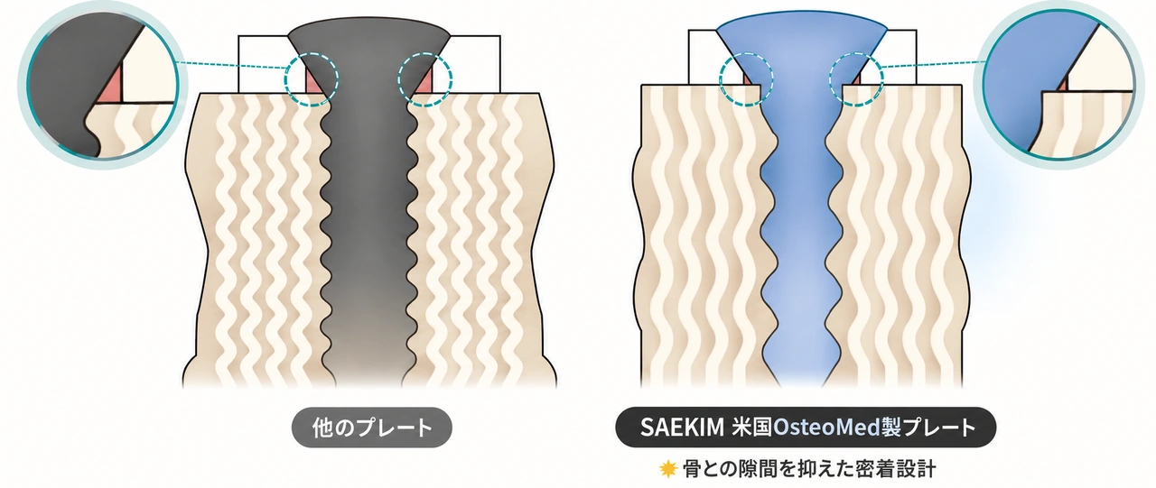 固定用スクリューの構造