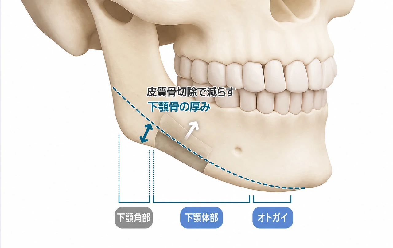 皮質骨の厚みを考慮したデザイン